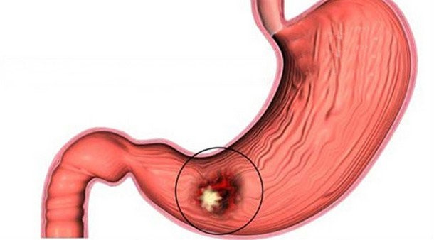 điều trị ung thư dạ dày giai đoạn 2